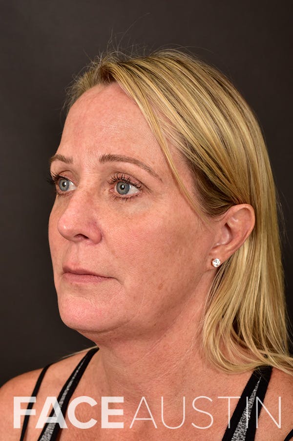 Facelift Before & After Gallery - Patient 206027 - Image 1