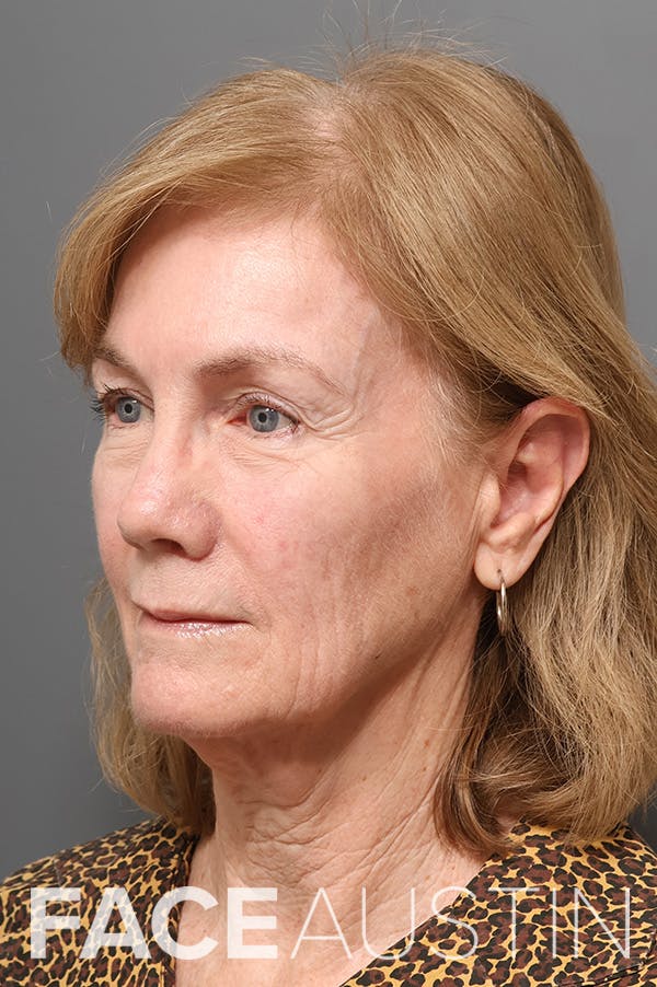 Facelift Before & After Gallery - Patient 262785 - Image 1