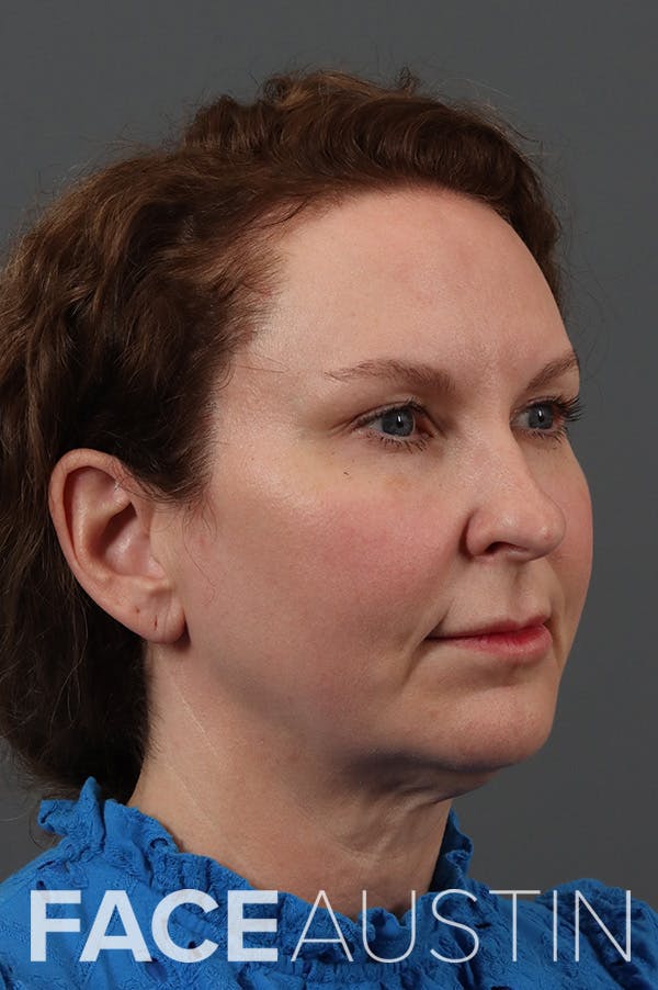 Facelift Before & After Gallery - Patient 374003 - Image 1