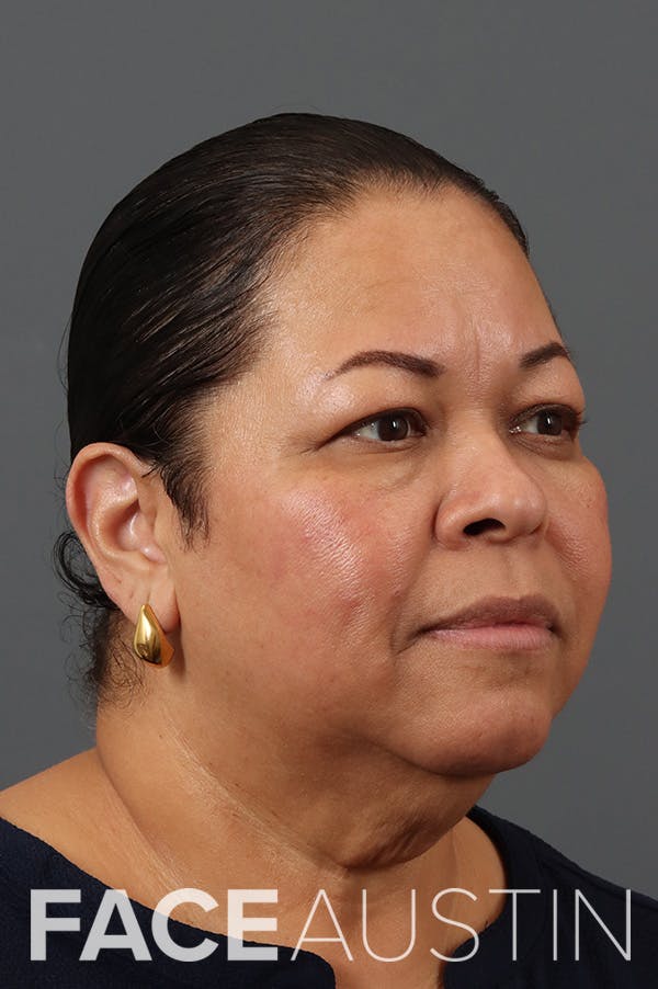 Facelift Before & After Gallery - Patient 260892 - Image 1