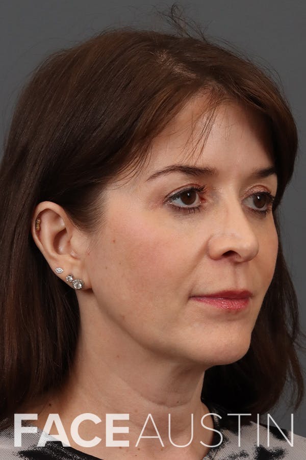 Facelift Before & After Gallery - Patient 266085 - Image 1