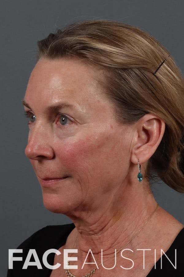 Facelift Before & After Gallery - Patient 545570 - Image 1