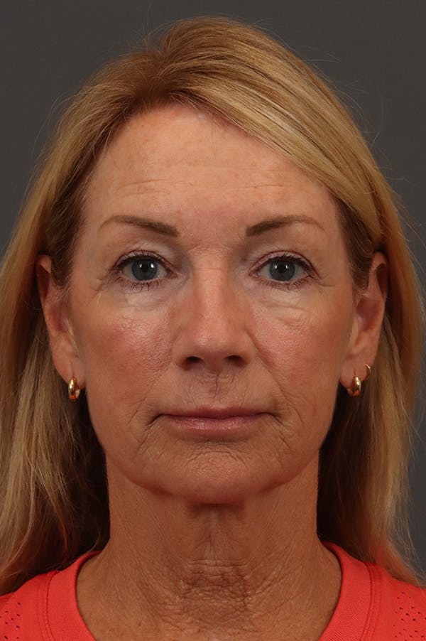 Facelift Before & After Gallery - Patient 199606 - Image 3