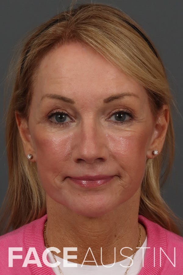 Facelift Before & After Gallery - Patient 199606 - Image 4