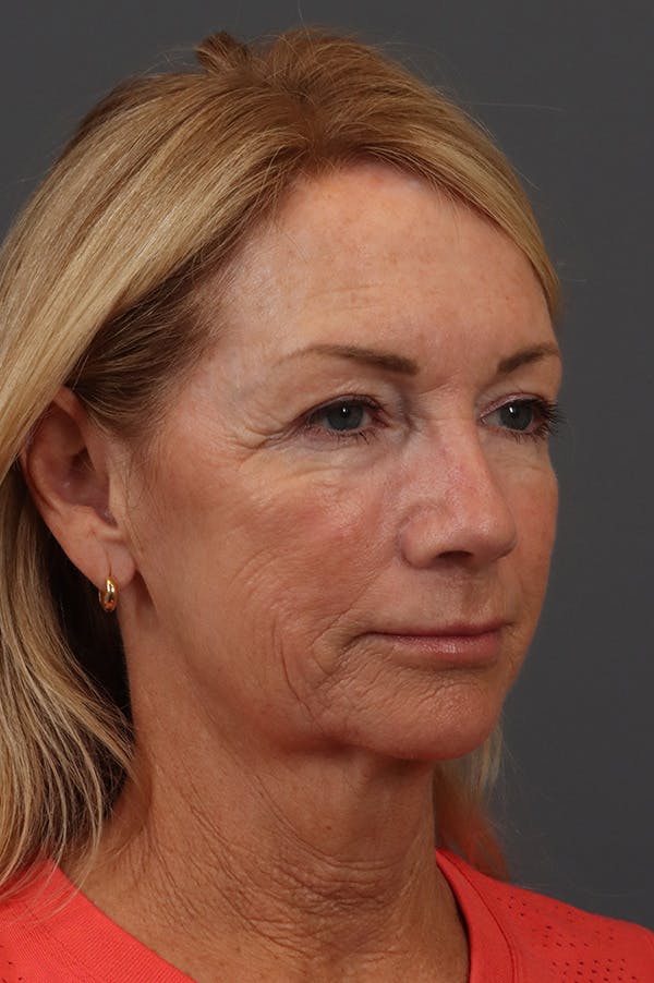 Facelift Before & After Gallery - Patient 199606 - Image 1