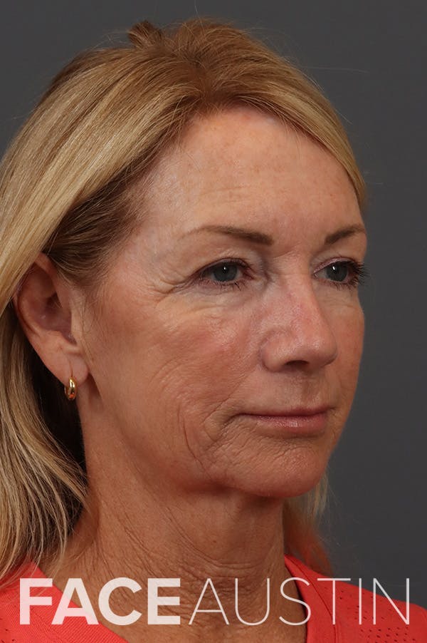 Facelift Before & After Gallery - Patient 199606 - Image 1