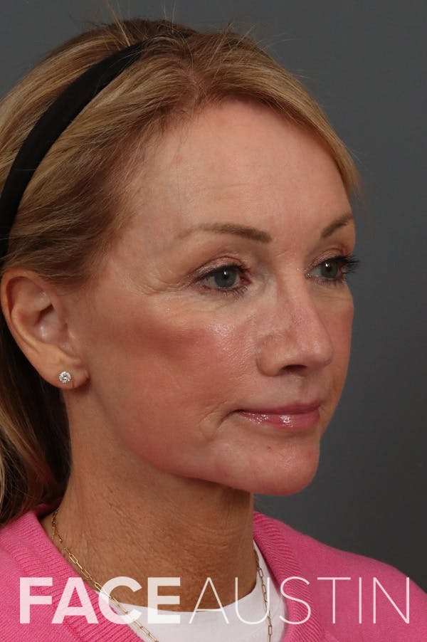 Facelift Before & After Gallery - Patient 199606 - Image 2