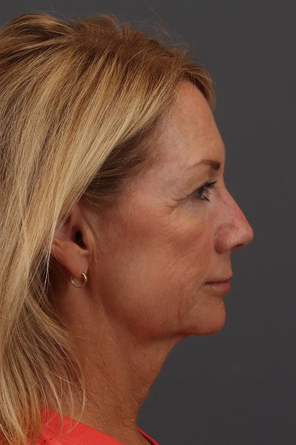 Facelift Before & After Gallery - Patient 199606 - Image 5