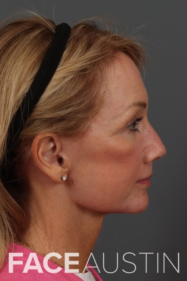 Facelift Before & After Gallery - Patient 199606 - Image 6