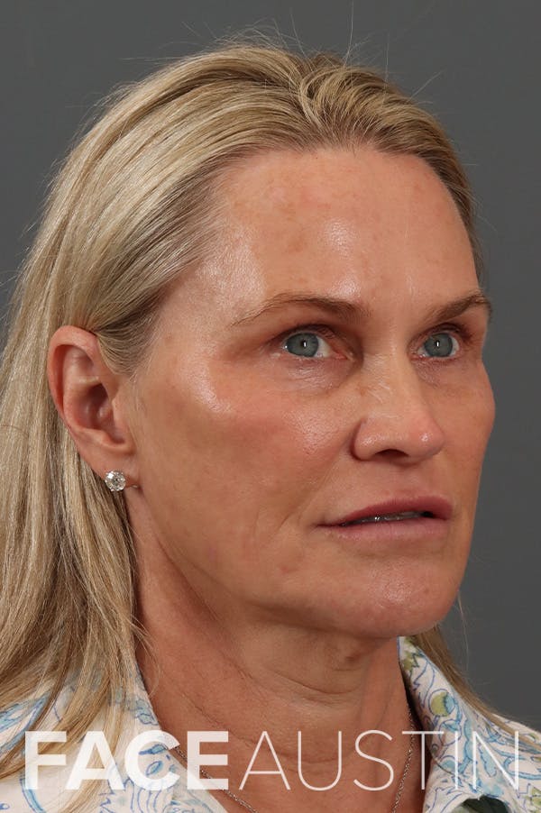 Facelift Before & After Gallery - Patient 322601 - Image 1