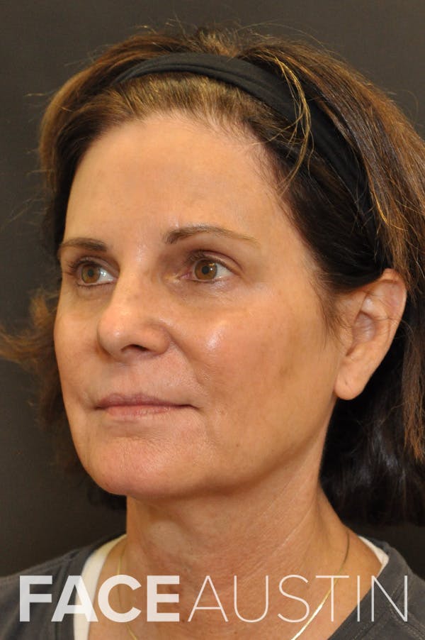 Facelift Before & After Gallery - Patient 106029 - Image 1