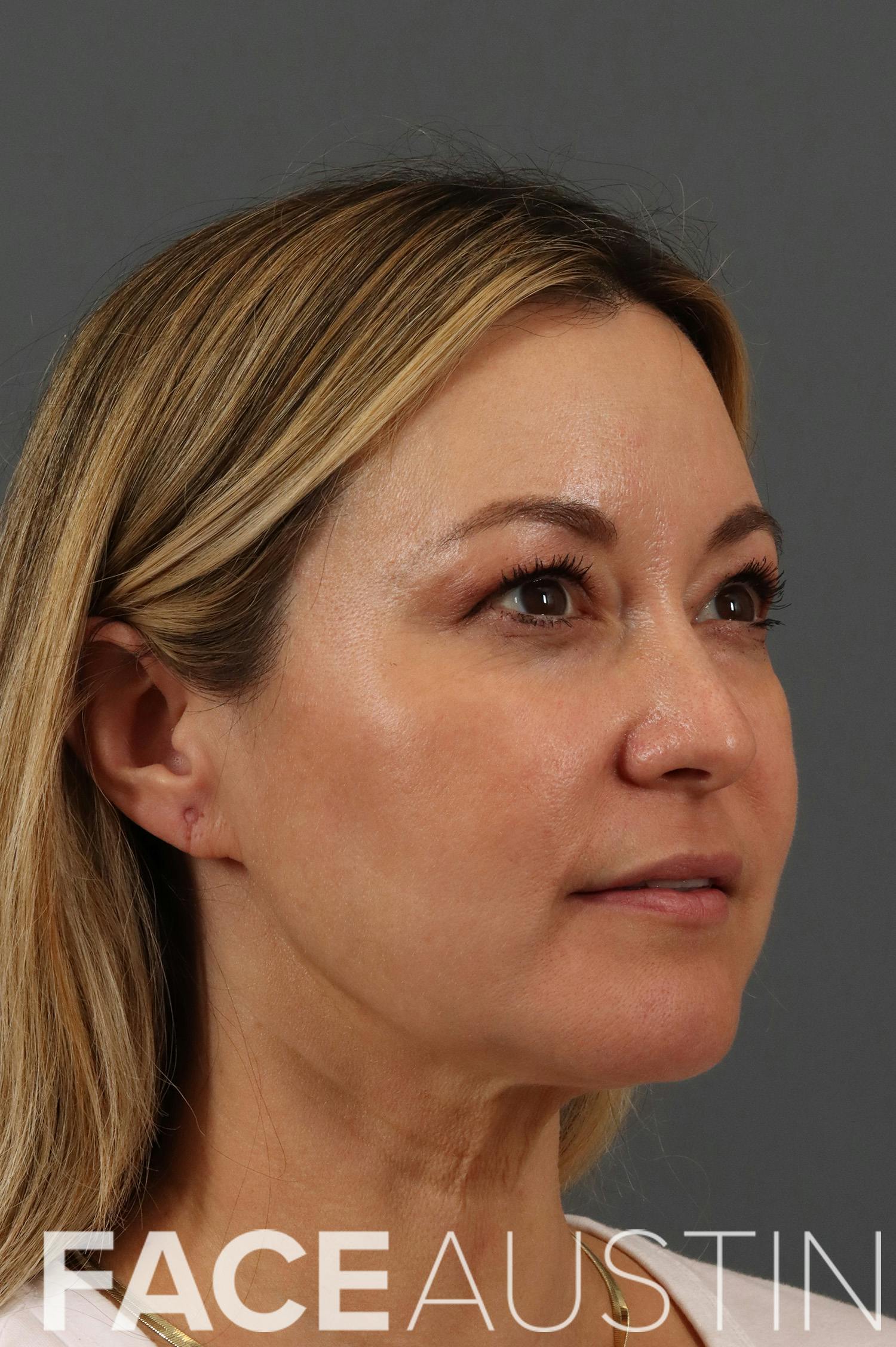 Facelift Before & After Gallery - Patient 482034 - Image 1