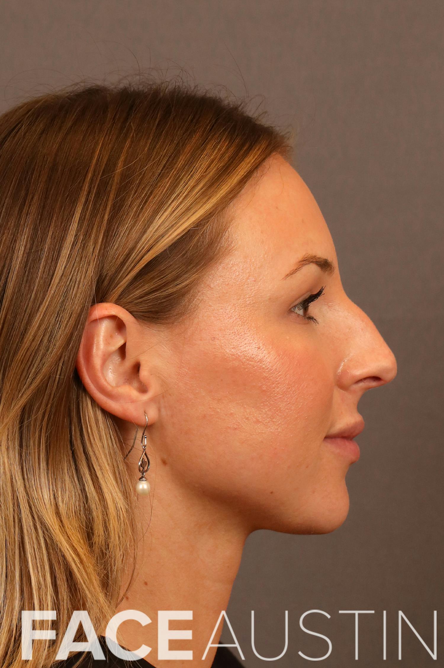 Rhinoplasty Before & After Gallery - Patient 297589 - Image 1