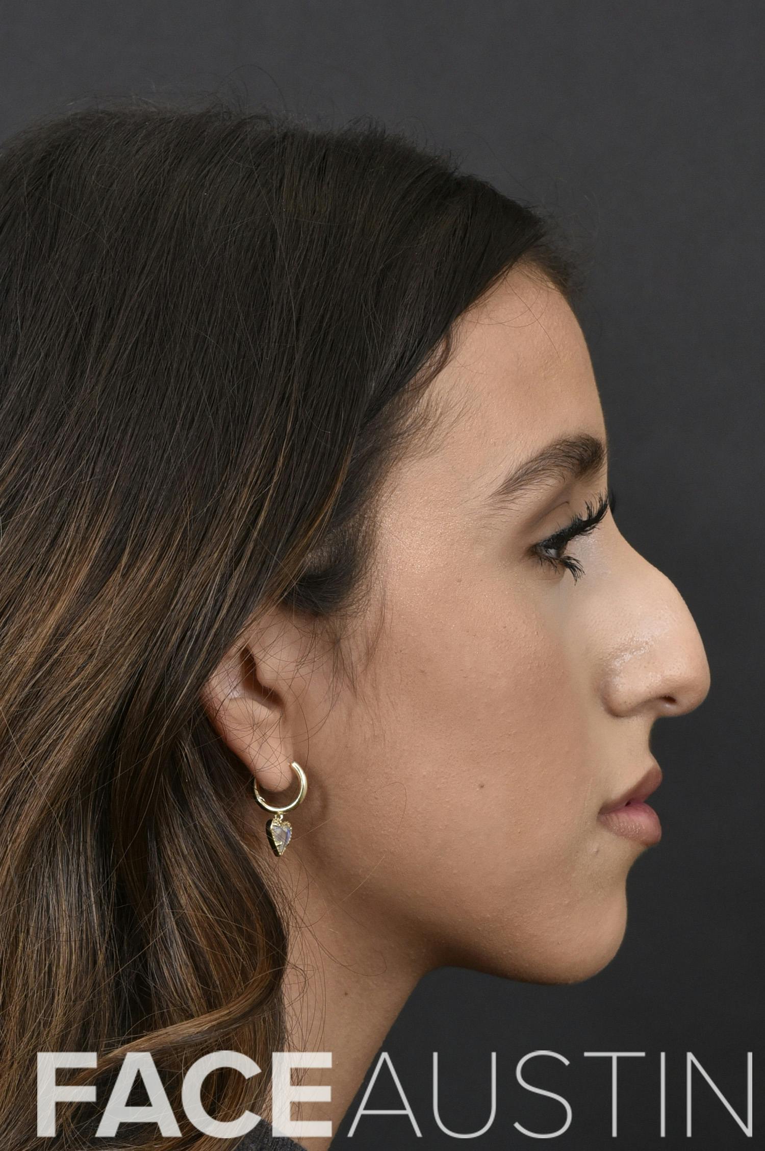Rhinoplasty Before & After Gallery - Patient 248670 - Image 1