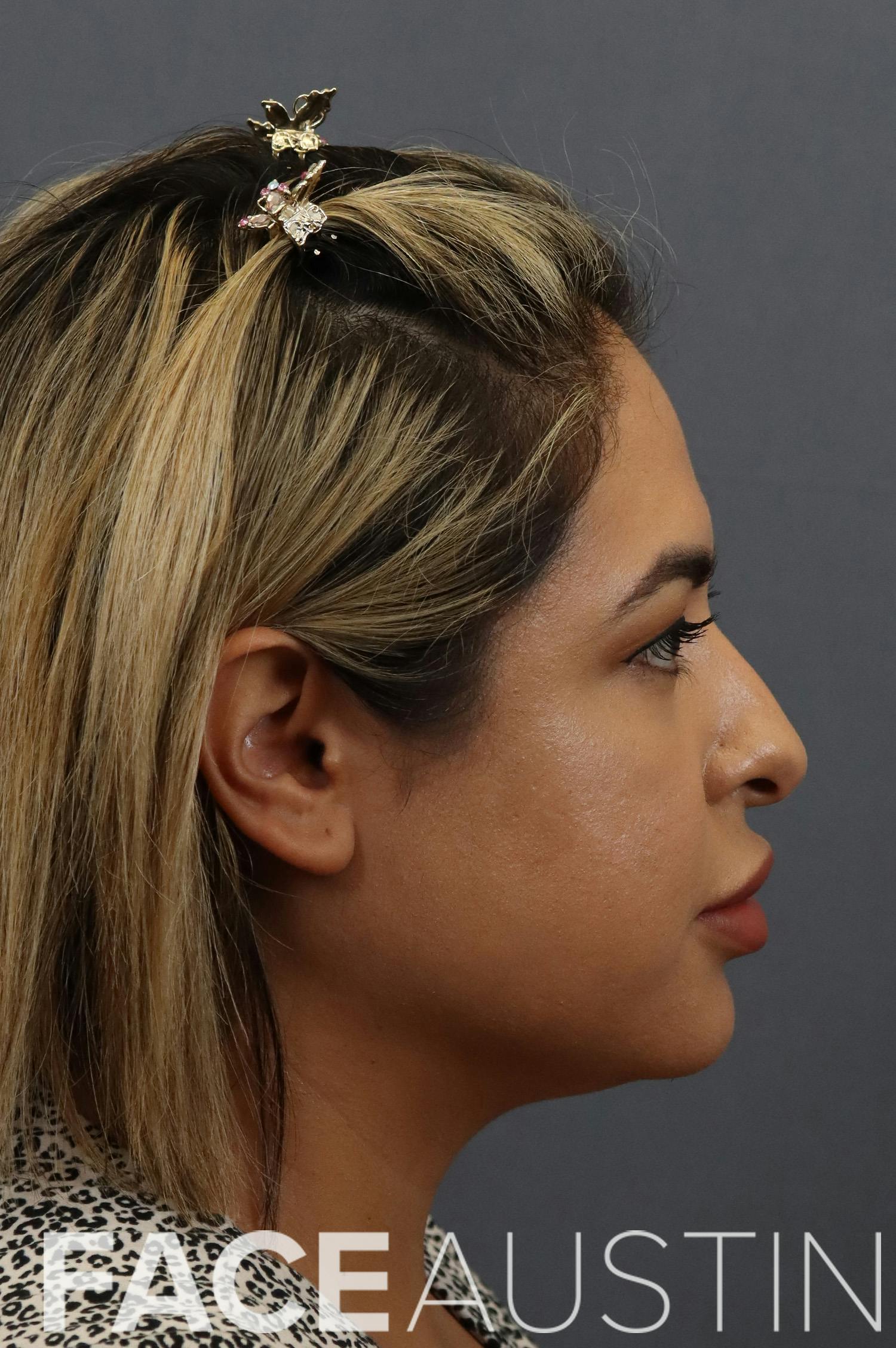 Rhinoplasty Before & After Gallery - Patient 116286 - Image 1