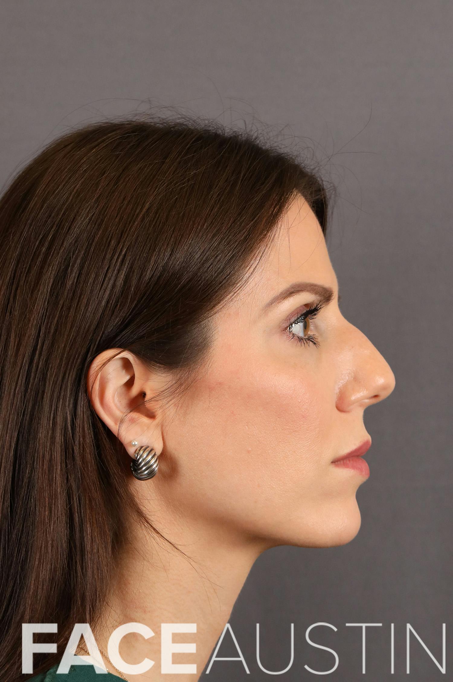 Rhinoplasty Before & After Gallery - Patient 231487 - Image 1