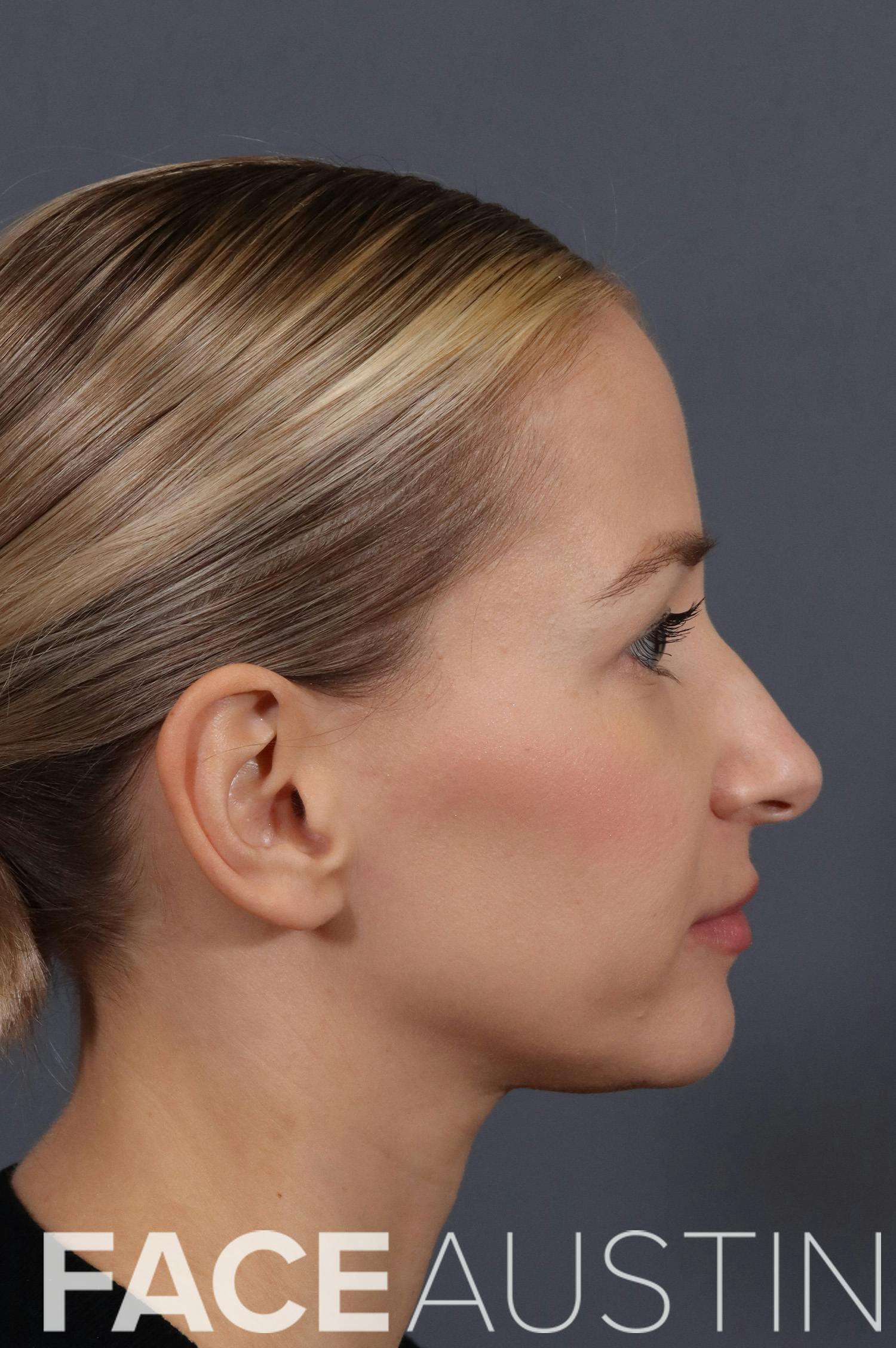 Rhinoplasty Before & After Gallery - Patient 215042 - Image 1