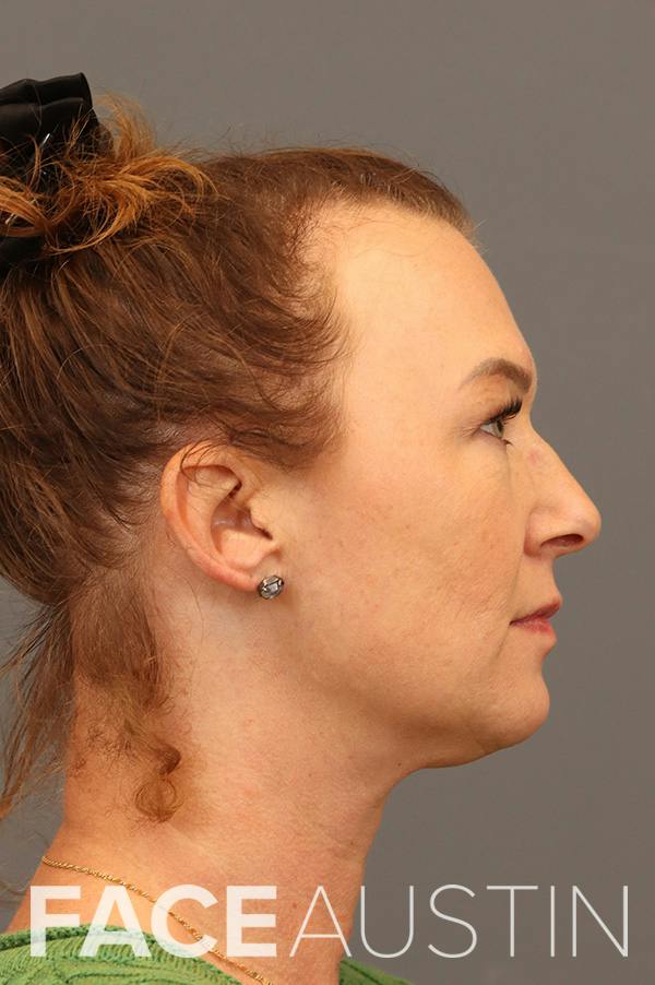 Rhinoplasty Before & After Gallery - Patient 403258 - Image 1