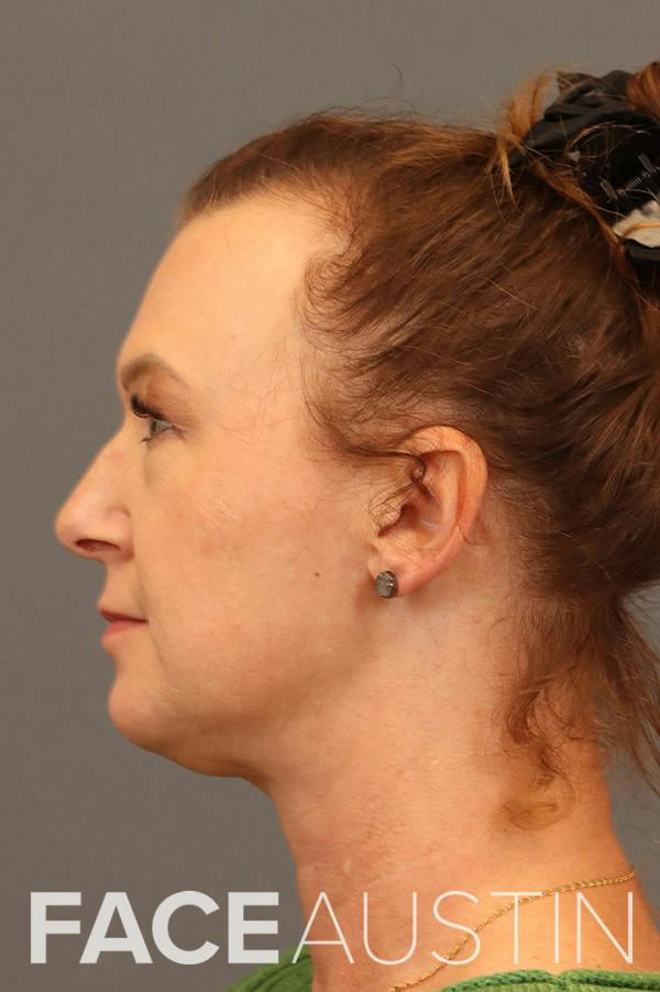 Revision Rhinoplasty Before & After Gallery - Patient 136756 - Image 1