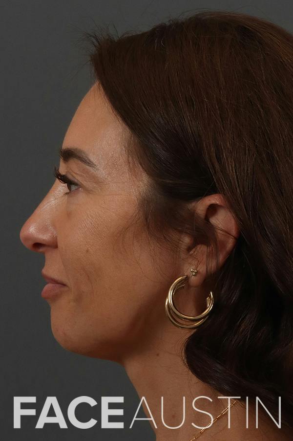 Revision Rhinoplasty Before & After Gallery - Patient 165778 - Image 1