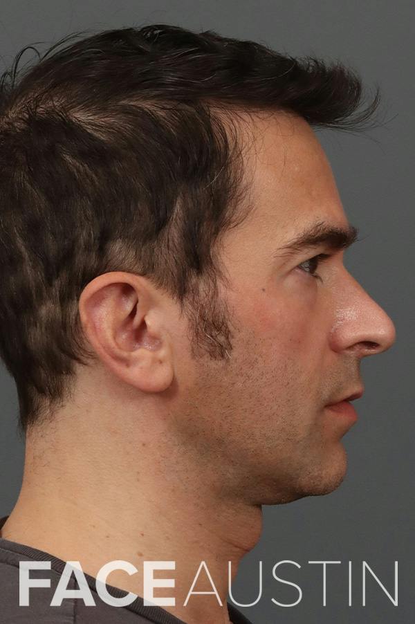 Rhinoplasty Before & After Gallery - Patient 337429 - Image 1