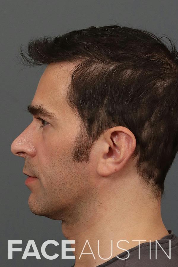 Revision Rhinoplasty Before & After Gallery - Patient 157966 - Image 1