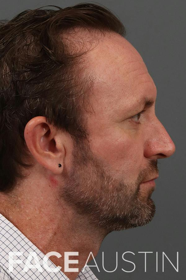 Rhinoplasty Before & After Gallery - Patient 370423 - Image 1