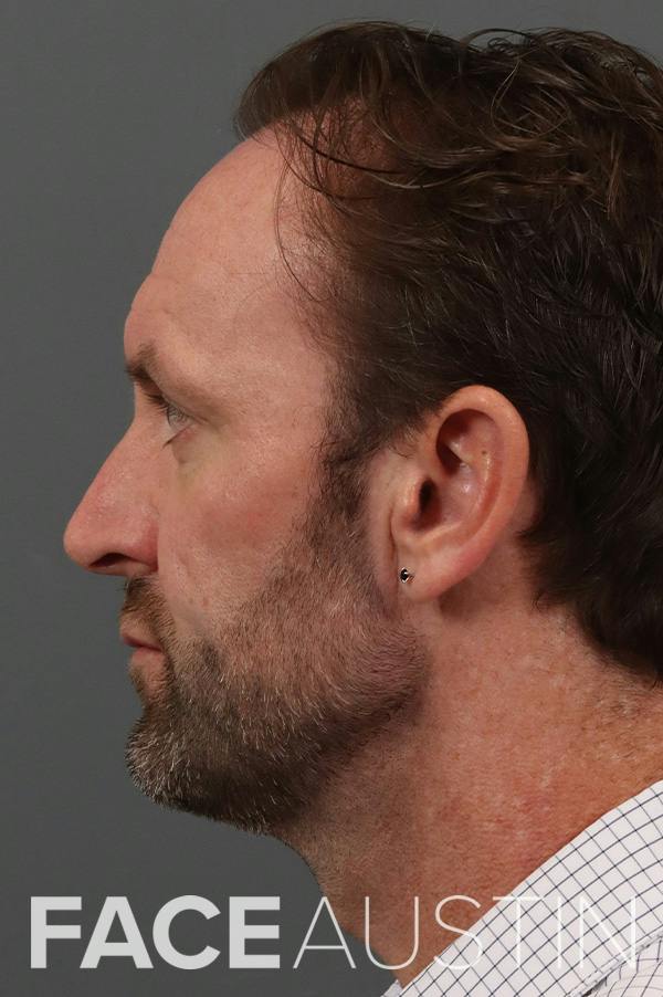 Revision Rhinoplasty Before & After Gallery - Patient 328062 - Image 1