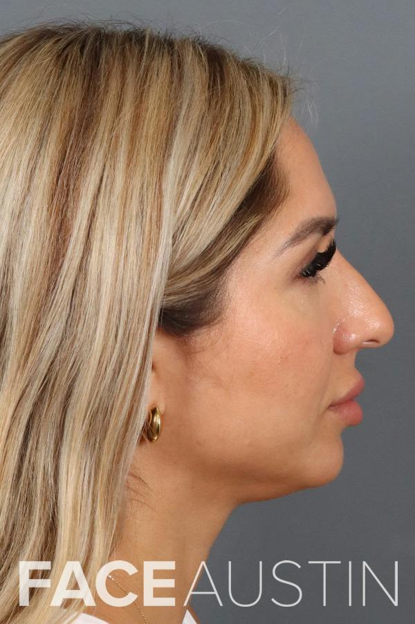 Rhinoplasty Before & After Gallery - Patient 372561 - Image 1