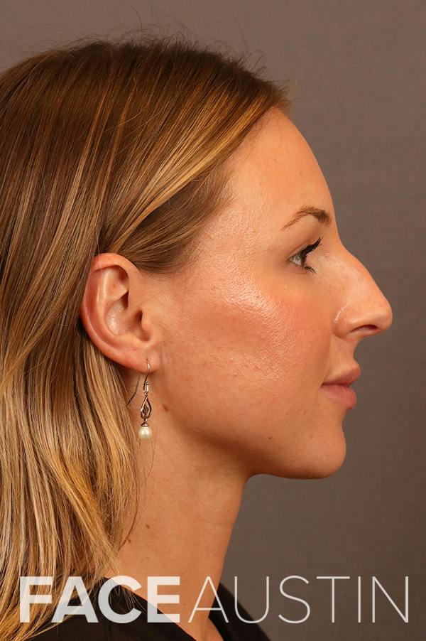 Rhinoplasty Before & After Gallery - Patient 422600 - Image 1