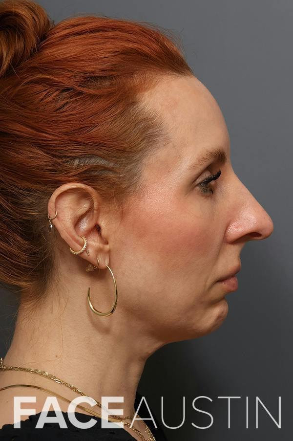 Rhinoplasty Before & After Gallery - Patient 382911 - Image 1