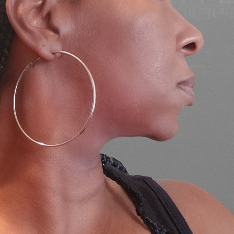 before AirSculpt chin liposuction