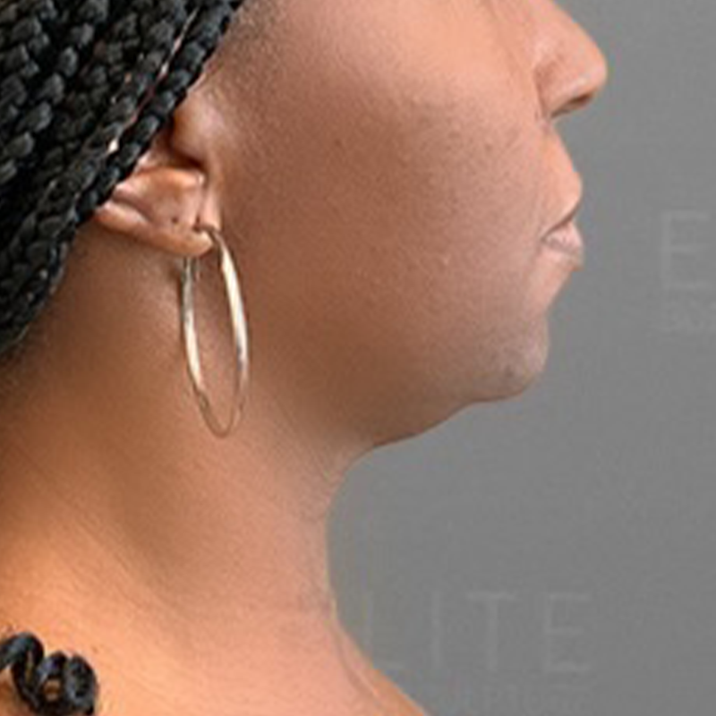 after AirSculpt Chin Liposuction