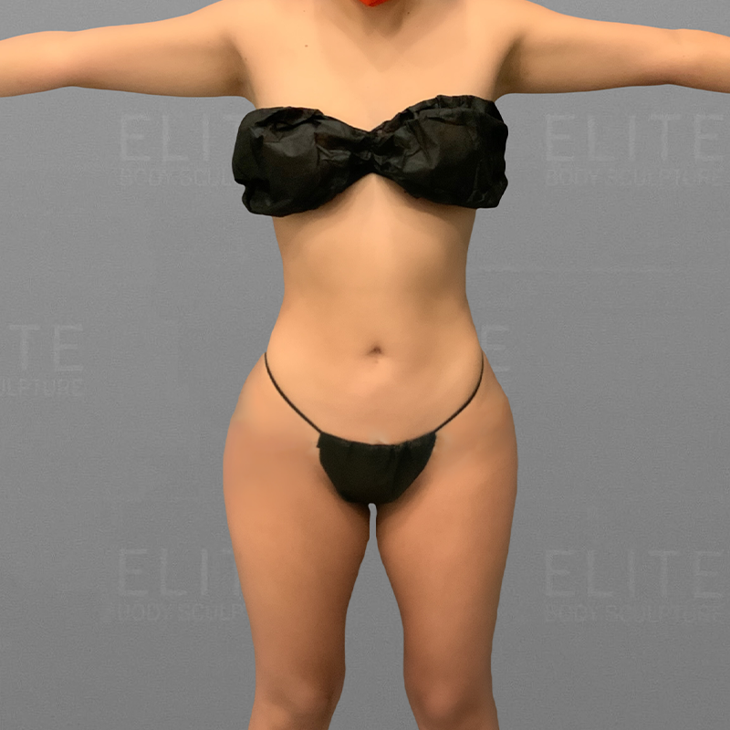 After Stomach AirSculpt