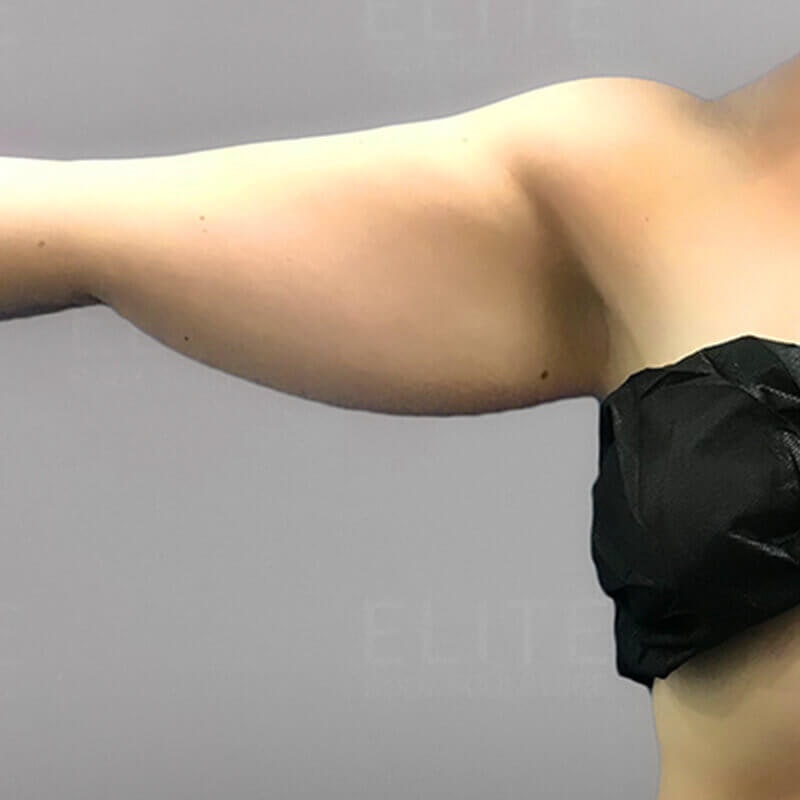 Before Arm AirSculpt
