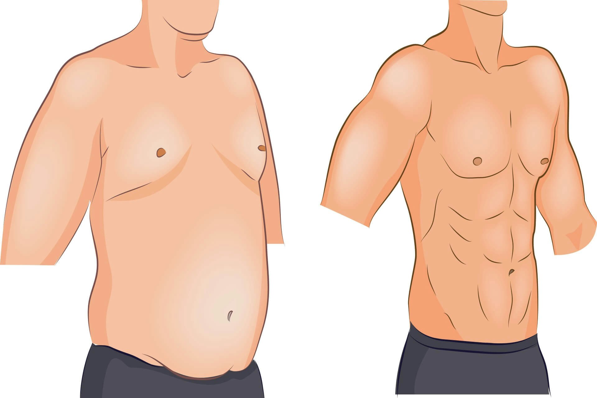 Gynecomastia Severity