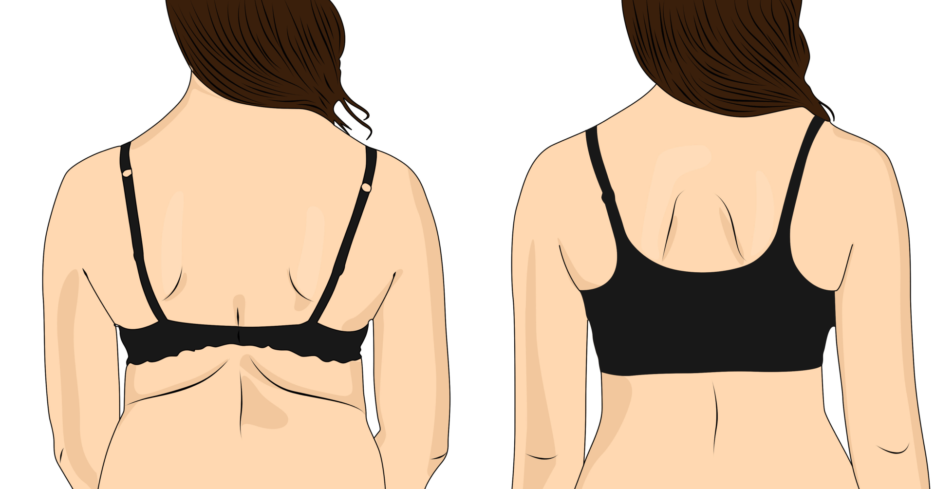 Bra Bulge Treatment
