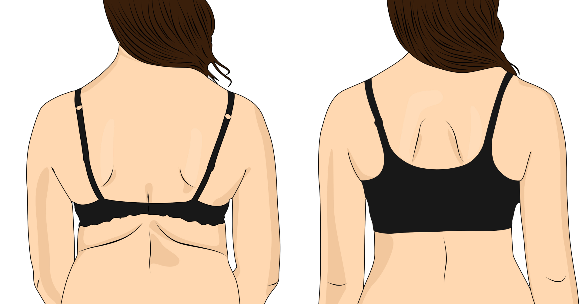 Three ways to address back rolls and bra rolls - San Francisco Bay Area  Plastic Surgery