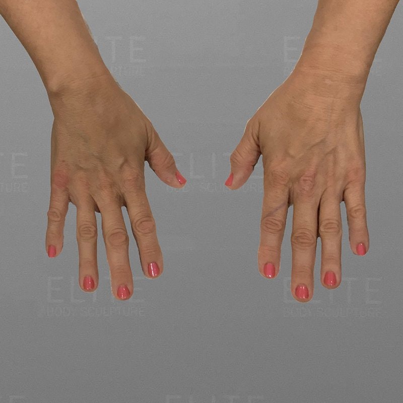 Hand Rejuvenation Before