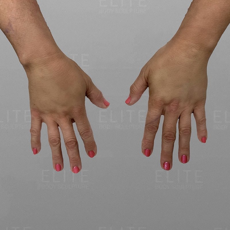 Hand Rejuvenation After