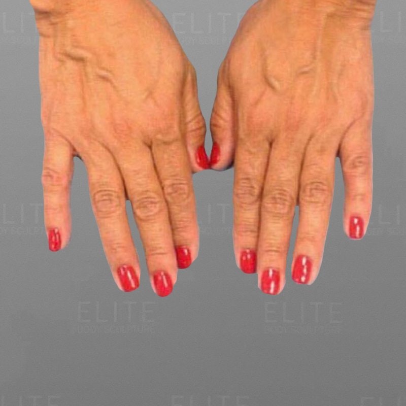 Hand Rejuvenation Before 2