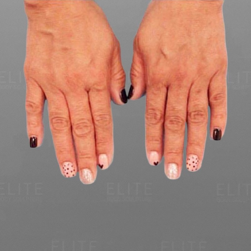 Hand Rejuvenation After 2