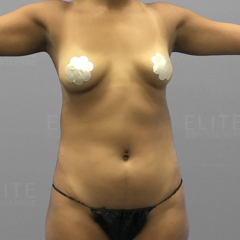 Upper Stomach Procedure Before
