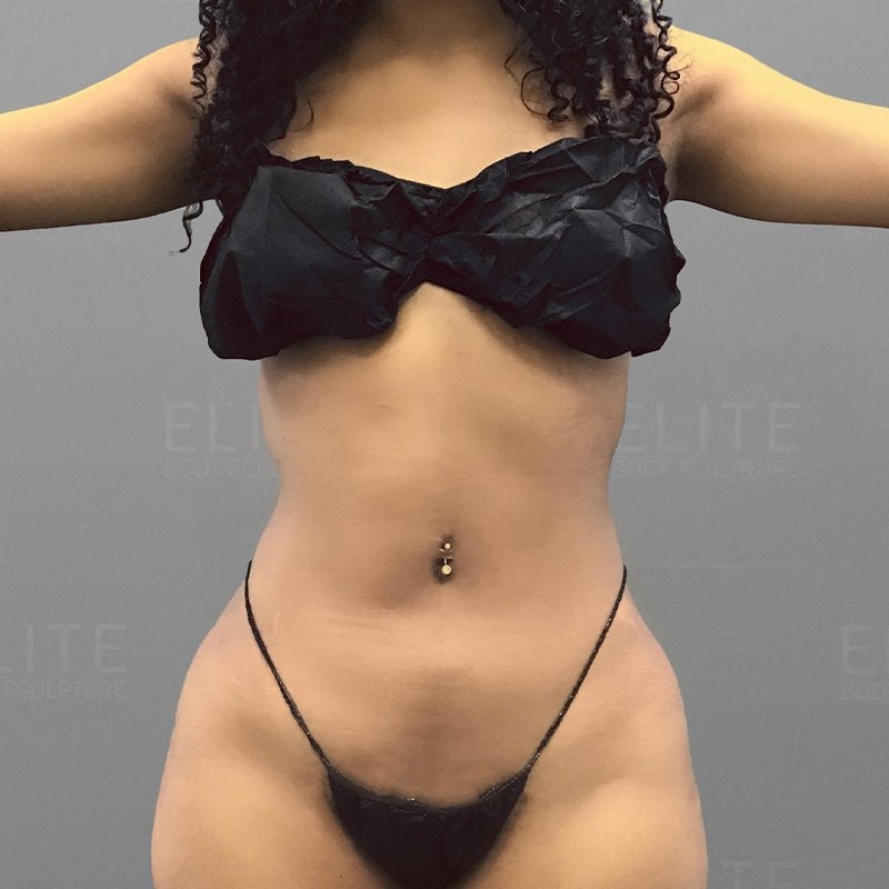 Upper Stomach Procedure After