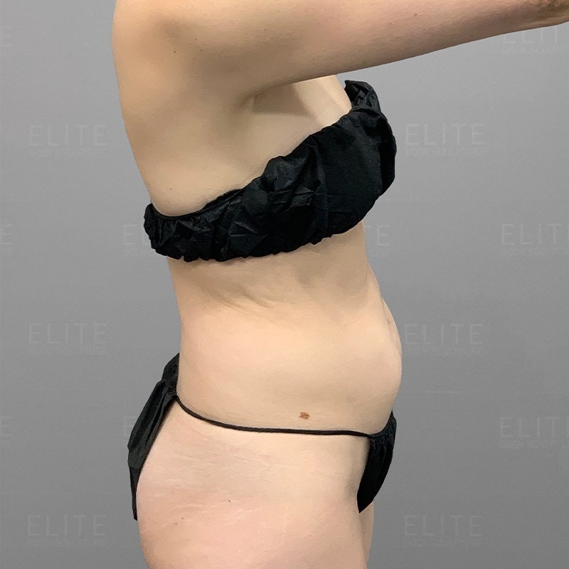 Lower Stomach Liposuction Before