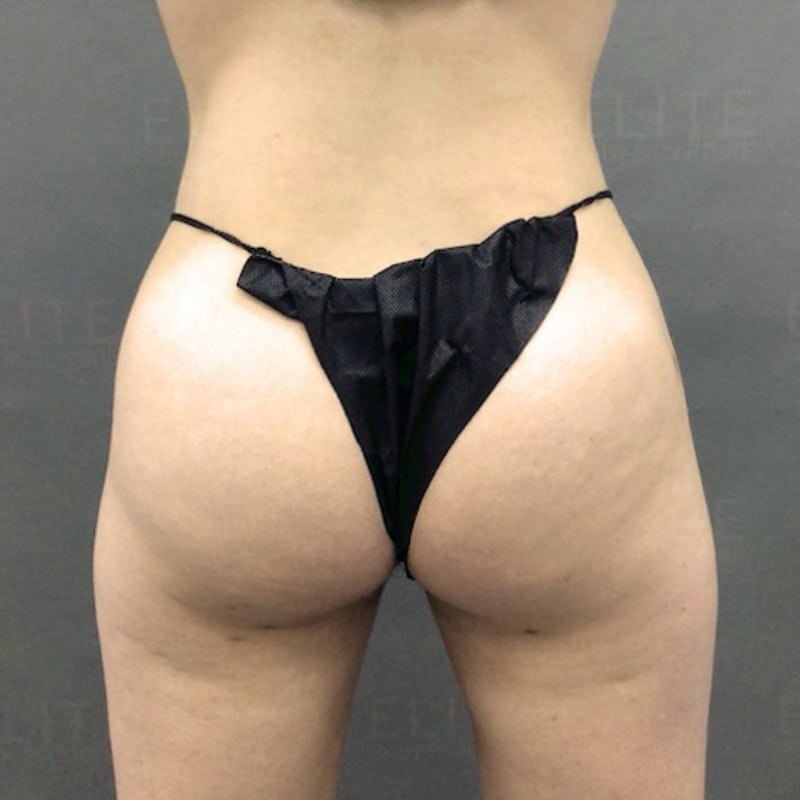 Waist Airsculpt After