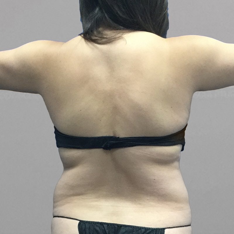 Upper Back Procedure Before
