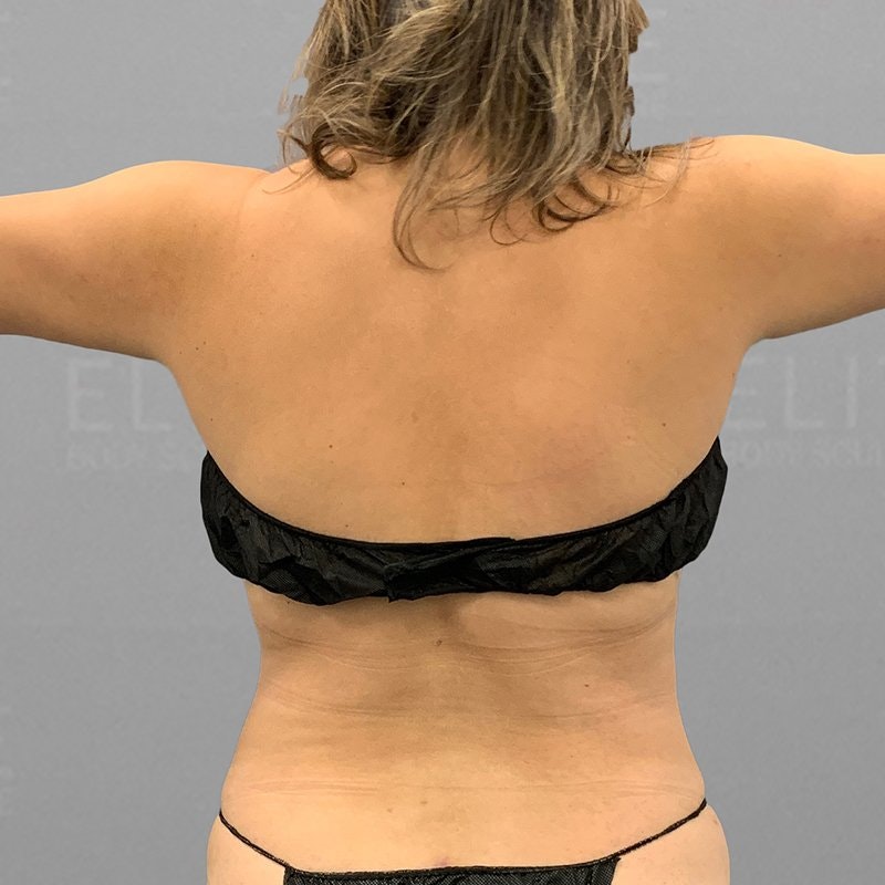 Upper Back Procedure After