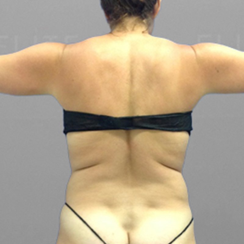 Upper Back Procedure Before 2