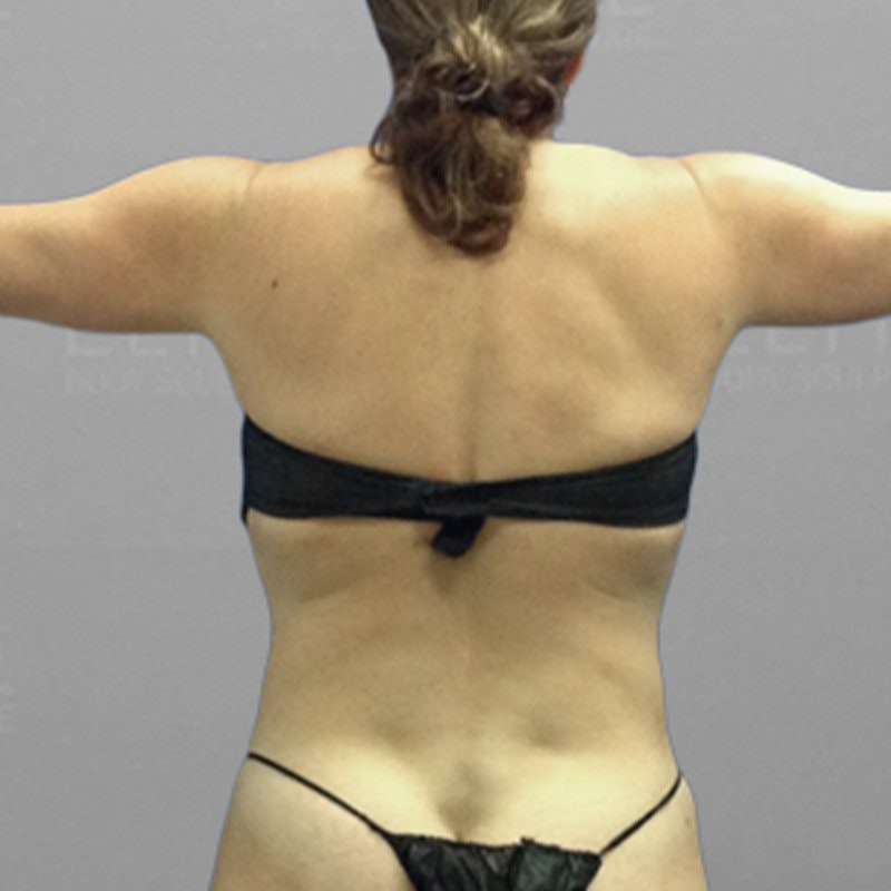 Upper Back Procedure After 2